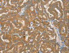 RAB25 Antibody - Immunohistochemistry of paraffin-embedded Human liver cancer using RAB25 Polyclonal Antibody at dilution of 1:40.
