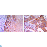 RAB25 Antibody - Immunohistochemistry (IHC) analysis of paraffin-embedded esophagus tissues (left) and Human Lung Cancer (right) with DAB staining using Rab 25 Monoclonal Antibody.