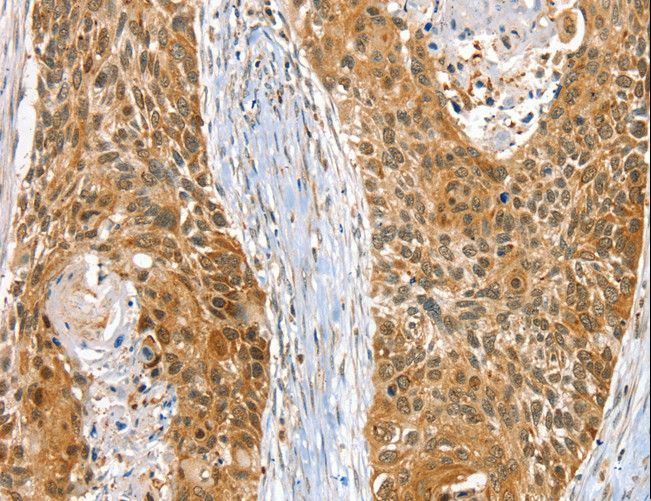 RAB27A / RAB27 Antibody - Immunohistochemistry of paraffin-embedded Human esophagus cancer using RAB27A Polyclonal Antibody at dilution of 1:30.