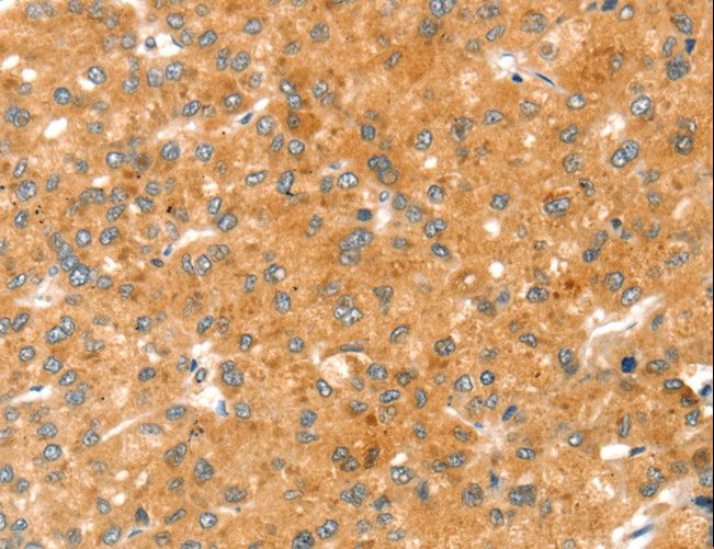 RAB27A / RAB27 Antibody - Immunohistochemistry of paraffin-embedded Human liver cancer using RAB27A Polyclonal Antibody at dilution of 1:30.