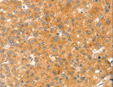 RAB27A / RAB27 Antibody - Immunohistochemistry of paraffin-embedded Human liver cancer using RAB27A Polyclonal Antibody at dilution of 1:30.