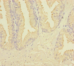 RAB27B Antibody - Immunohistochemistry of paraffin-embedded human prostate cancer at dilution of 1:100