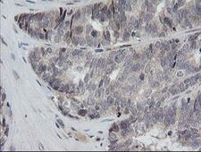 RAB30 Antibody - IHC of paraffin-embedded Adenocarcinoma of Human ovary tissue using anti-RAB30 mouse monoclonal antibody. (Heat-induced epitope retrieval by 10mM citric buffer, pH6.0, 120°C for 3min).