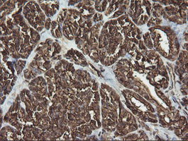 RAB30 Antibody - IHC of paraffin-embedded Carcinoma of Human thyroid tissue using anti-RAB30 mouse monoclonal antibody.