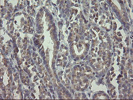 RAB30 Antibody - IHC of paraffin-embedded Carcinoma of Human thyroid tissue using anti-RAB30 mouse monoclonal antibody.