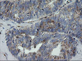 RAB30 Antibody - IHC of paraffin-embedded Adenocarcinoma of Human ovary tissue using anti-RAB30 mouse monoclonal antibody. (Heat-induced epitope retrieval by 10mM citric buffer, pH6.0, 120°C for 3min).