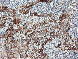 RAB30 Antibody - IHC of paraffin-embedded Human lymphoma tissue using anti-RAB30 mouse monoclonal antibody. (Heat-induced epitope retrieval by 10mM citric buffer, pH6.0, 120°C for 3min).
