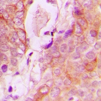 RAB34 Antibody - Immunohistochemical analysis of RAB34 staining in human breast cancer formalin fixed paraffin embedded tissue section. The section was pre-treated using heat mediated antigen retrieval with sodium citrate buffer (pH 6.0). The section was then incubated with the antibody at room temperature and detected with HRP and DAB as chromogen. The section was then counterstained with hematoxylin and mounted with DPX.