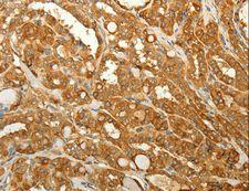 RAB35 Antibody - Immunohistochemistry of paraffin-embedded Human liver cancer using RAB35 Polyclonal Antibody at dilution of 1:50.