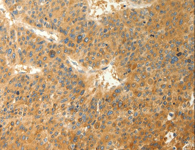 RAB35 Antibody - Immunohistochemistry of paraffin-embedded Human thyroid cancer using RAB35 Polyclonal Antibody at dilution of 1:40.