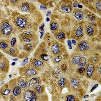 RAB37 Antibody - Immunohistochemical analysis of RAB37 staining in human liver cancer formalin fixed paraffin embedded tissue section. The section was pre-treated using heat mediated antigen retrieval with sodium citrate buffer (pH 6.0). The section was then incubated with the antibody at room temperature and detected using an HRP polymer system. DAB was used as the chromogen. The section was then counterstained with hematoxylin and mounted with DPX.