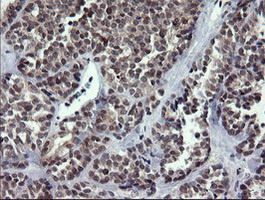 RAB37 Antibody - IHC of paraffin-embedded Carcinoma of Human thyroid tissue using anti-RAB37 mouse monoclonal antibody.