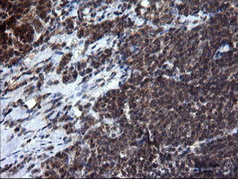 RAB37 Antibody - IHC of paraffin-embedded Human lymphoma tissue using anti-RAB37 mouse monoclonal antibody.