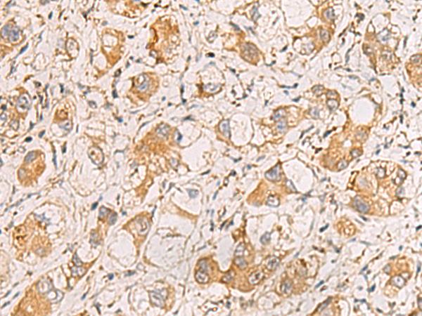 RAB38 Antibody - Immunohistochemistry of paraffin-embedded Human liver cancer tissue  using RAB38 Polyclonal Antibody at dilution of 1:60(×200)