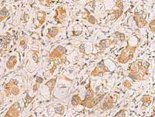 RAB38 Antibody - Immunohistochemistry of paraffin-embedded Human liver cancer tissue  using RAB38 Polyclonal Antibody at dilution of 1:60(×200)