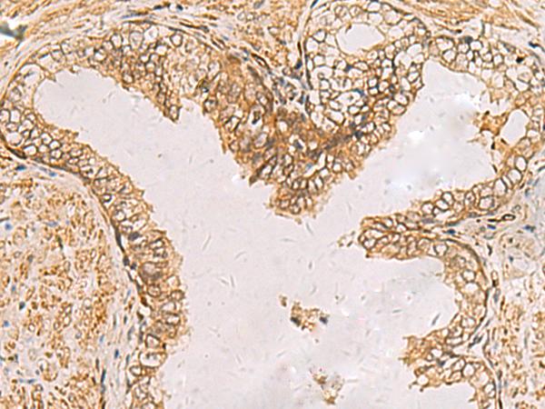 RAB38 Antibody - Immunohistochemistry of paraffin-embedded Human prost ate cancer tissue  using RAB38 Polyclonal Antibody at dilution of 1:60(×200)