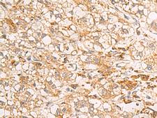 RAB38 Antibody - Immunohistochemistry of paraffin-embedded Human liver cancer tissue  using RAB38 Polyclonal Antibody at dilution of 1:50(×200)
