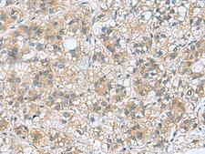 RAB39 / RAB39A Antibody - Immunohistochemistry of paraffin-embedded Human liver cancer tissue  using RAB39A Polyclonal Antibody at dilution of 1:70(×200)