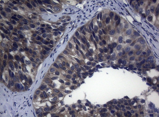 RAB3A Antibody - Immunohistochemical staining of paraffin-embedded Carcinoma of Human kidney tissue using anti-RAB3A mouse monoclonal antibody. (Heat-induced epitope retrieval by 1mM EDTA in 10mM Tris buffer. (pH8.5) at 120°C for 3 min. (1:150)