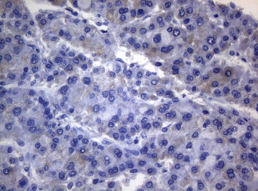 RAB3A Antibody - Immunohistochemical staining of paraffin-embedded Carcinoma of Human liver tissue using anti-RAB3A mouse monoclonal antibody. (Heat-induced epitope retrieval by 1mM EDTA in 10mM Tris buffer. (pH8.5) at 120°C for 3 min. (1:150)