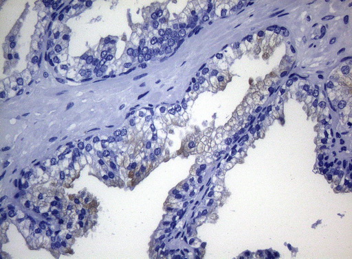 RAB3A Antibody - Immunohistochemical staining of paraffin-embedded Carcinoma of Human prostate tissue using anti-RAB3A mouse monoclonal antibody. (Heat-induced epitope retrieval by 1mM EDTA in 10mM Tris buffer. (pH8.5) at 120°C for 3 min. (1:150)