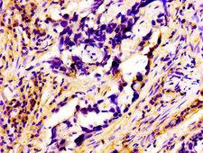 RAB3A Antibody - Immunohistochemistry image of paraffin-embedded human pancreatic cancer at a dilution of 1:100