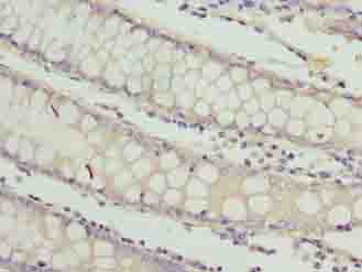 RAB3B Antibody - Immunohistochemistry of paraffin-embedded human colon cancer using antibody at dilution of 1:100.