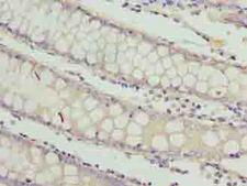 RAB3B Antibody - Immunohistochemistry of paraffin-embedded human colon cancer using antibody at dilution of 1:100.
