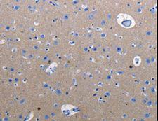 RAB3C Antibody - Immunohistochemistry of paraffin-embedded Human cervical cancer using RAB3c Polyclonal Antibody at dilution of 1:25.