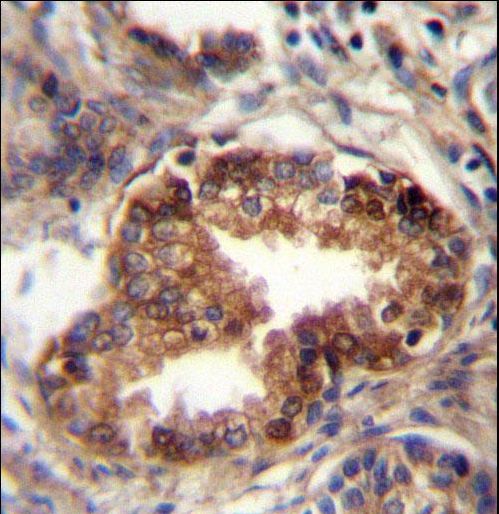 RAB3D Antibody - RAB3D Antibody immunohistochemistry of formalin-fixed and paraffin-embedded human prostate carcinoma followed by peroxidase-conjugated secondary antibody and DAB staining.