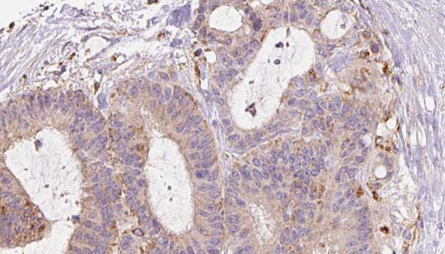 RAB3D Antibody - 1:100 staining human liver carcinoma tissues by IHC-P. The sample was formaldehyde fixed and a heat mediated antigen retrieval step in citrate buffer was performed. The sample was then blocked and incubated with the antibody for 1.5 hours at 22°C. An HRP conjugated goat anti-rabbit antibody was used as the secondary.