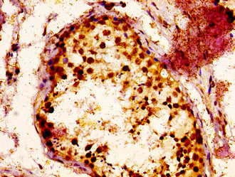 RAB3GAP1 Antibody - Immunohistochemistry image at a dilution of 1:300 and staining in paraffin-embeddedhuman testis tissue performed on a Leica BondTM system. After dewaxing and hydration, antigen retrieval was mediated by high pressure in a citrate buffer (pH 6.0) . Section was blocked with 10% normal goat serum 30min at RT. Then primary antibody (1% BSA) was incubated at 4 °C overnight. The primary is detected by a biotinylated secondary antibody and visualized using an HRP conjugated ABC system.