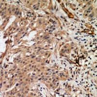 RAB3GAP2 / p150 Antibody - Immunohistochemical analysis of RAB3GAP2 staining in human breast cancer formalin fixed paraffin embedded tissue section. The section was pre-treated using heat mediated antigen retrieval with sodium citrate buffer (pH 6.0). The section was then incubated with the antibody at room temperature and detected using an HRP conjugated compact polymer system. DAB was used as the chromogen. The section was then counterstained with haematoxylin and mounted with DPX.