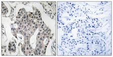 RAB3GAP2 / p150 Antibody - Peptide - + Immunohistochemistry analysis of paraffin-embedded human breast carcinoma tissue using RAB3GAP2 antibody.
