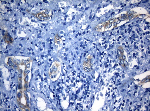 RAB3IP / RABIN3 Antibody - Immunohistochemical staining of paraffin-embedded Carcinoma of Human liver tissue using anti-RAB3IP mouse monoclonal antibody. (Heat-induced epitope retrieval by 1mM EDTA in 10mM Tris buffer. (pH8.5) at 120°C for 3 min. (1:150)
