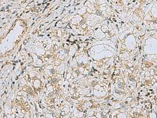 RAB3IP / RABIN3 Antibody - Immunohistochemistry of paraffin-embedded Human liver cancer tissue  using RAB3IP Polyclonal Antibody at dilution of 1:60(×200)