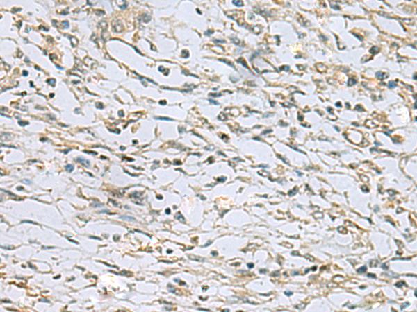 RAB3IP / RABIN3 Antibody - Immunohistochemistry of paraffin-embedded Human prost ate cancer tissue  using RAB3IP Polyclonal Antibody at dilution of 1:60(×200)