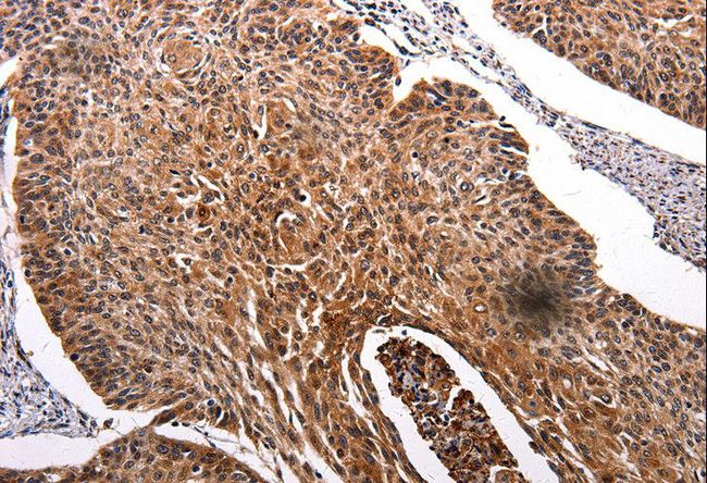 RAB41 Antibody - Immunohistochemistry of paraffin-embedded Human renal cancer using RAB41 Polyclonal Antibody at dilution of 1:100.