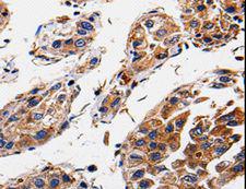 RAB41 Antibody - Immunohistochemistry of paraffin-embedded Human liver cancer using RAB41 Polyclonal Antibody at dilution of 1:60.
