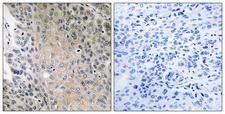 RAB41 Antibody - Peptide - + Immunohistochemistry analysis of paraffin-embedded human lung carcinoma tissue using RAB41 antibody.