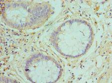 RAB5A / RAB5 Antibody - Immunohistochemistry of paraffin-embedded human rectal cancer using antibody at 1:100 dilution.