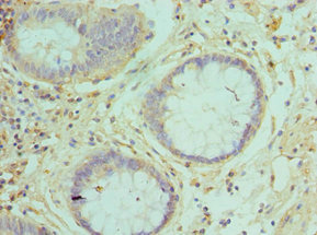 RAB5A / RAB5 Antibody - Immunohistochemistry of paraffin-embedded human colon cancer using RAB5A Antibody at dilution of 1:100