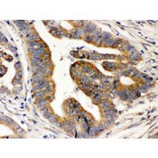 RAB5A / RAB5 Antibody - Rab5 antibody IHC-paraffin. IHC(P): Human Intestinal Cancer Tissue.