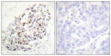 RAB6KIFL / KIF20A Antibody - Peptide - + Immunohistochemistry analysis of paraffin-embedded human breast carcinoma tissue using KIF20A (Ab-528) antibody.