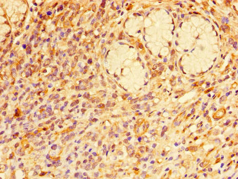 RAB7A / RAB7 Antibody - Immunohistochemistry of paraffin-embedded human gastric cancer tissue using RAB7A Antibody at dilution of 1:100