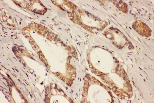 RAB8A / RAB8 Antibody - RAB8A / RAB8 antibody. IHC(P): Human Intestinal Cancer Tissue.