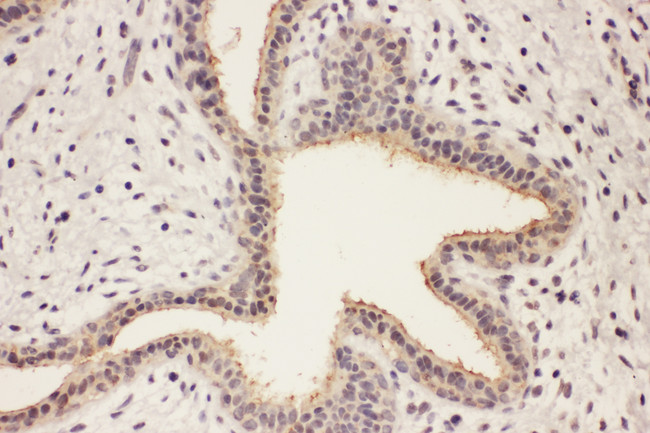 RAB8A / RAB8 Antibody - RAB8A / RAB8 antibody. IHC(P): Human Breast Cancer Tissue.