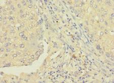 RAB8B Antibody - Immunohistochemistry of paraffin-embedded human lung cancer using RAB8B Antibody at dilution of 1:100