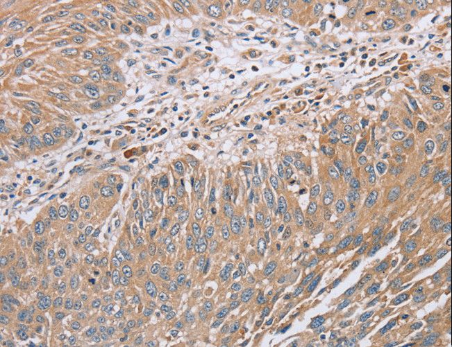 RAB8B Antibody - Immunohistochemistry of paraffin-embedded Human lung cancer using RAB8B Polyclonal Antibody at dilution of 1:45.