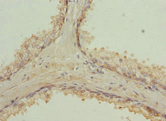 RAB9A / RAB9 Antibody - Immunohistochemistry of paraffin-embedded human prostate cancer at dilution 1:100